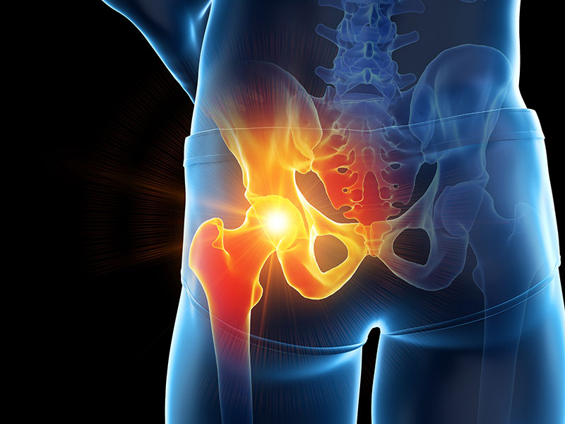 髖關節手術