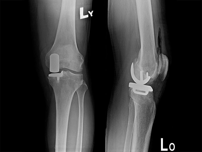 傳統部分膝置換