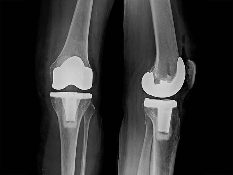 傳統全膝關節置換