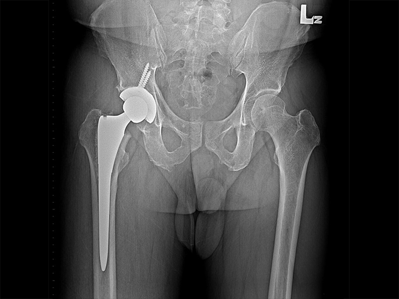 傳統髖關節置換